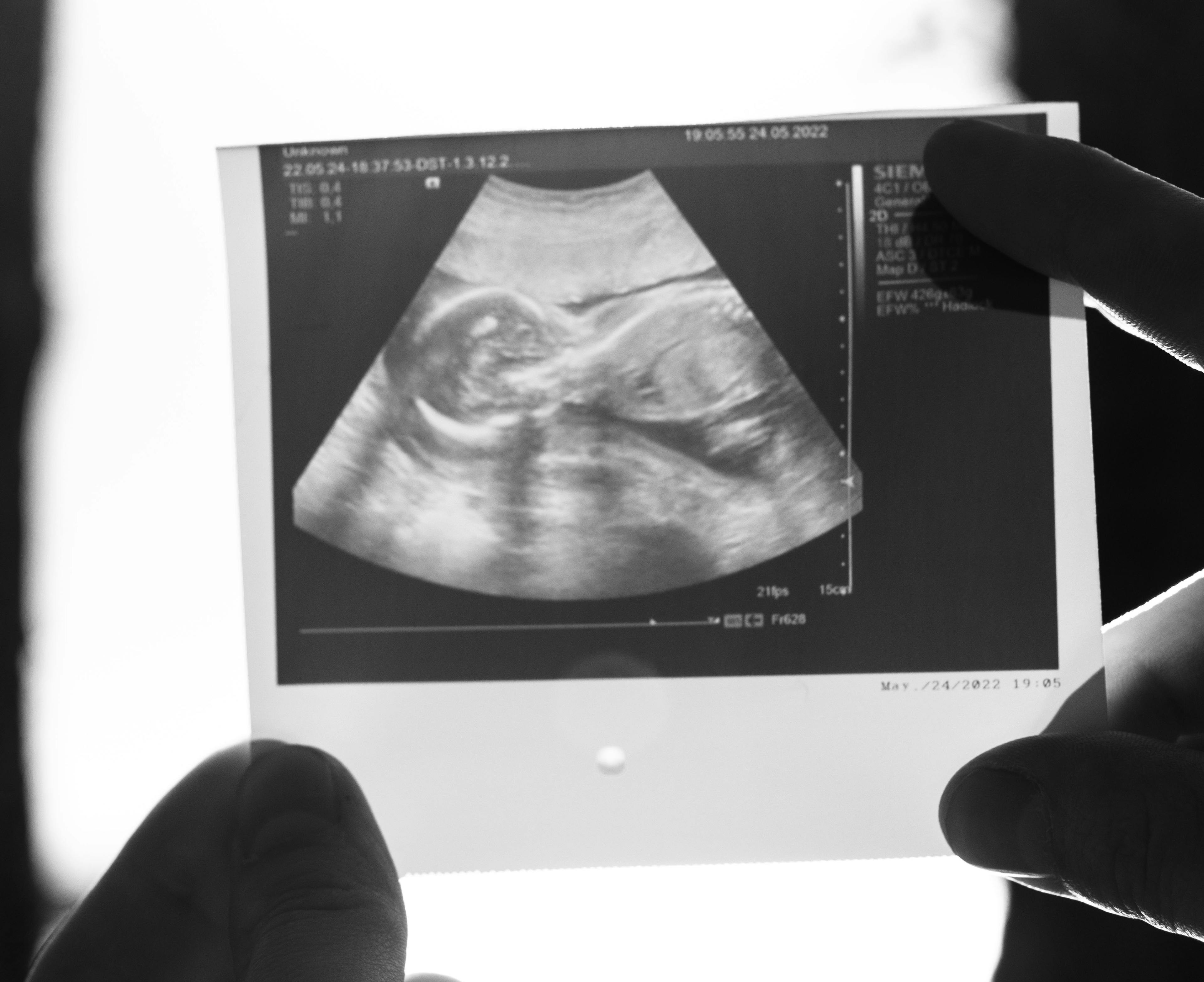 CDC report reveals significant shift in national abortion statistics since Dobbs ruling
