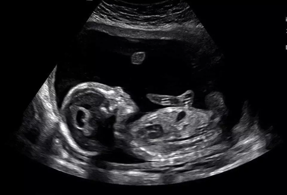 Faith, courage, and love - Family responds to prenatal diagnosis